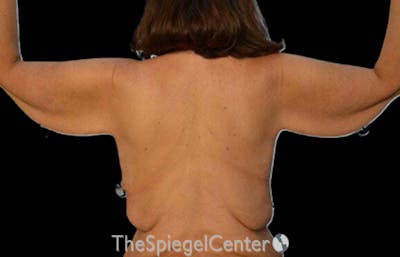 Arm Lift Before & After Gallery - Patient 233872 - Image 1