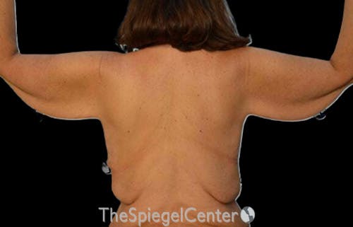 Arm Lift Before & After Gallery - Patient 233872 - Image 1