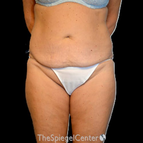 Body Contouring Before & After Gallery - Patient 410805 - Image 1
