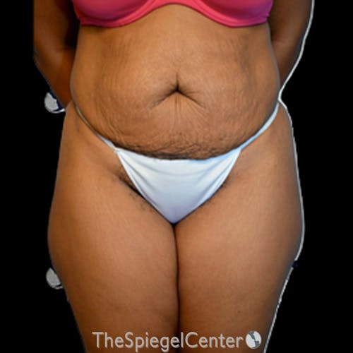 Body Contouring Before & After Gallery - Patient 147609 - Image 1