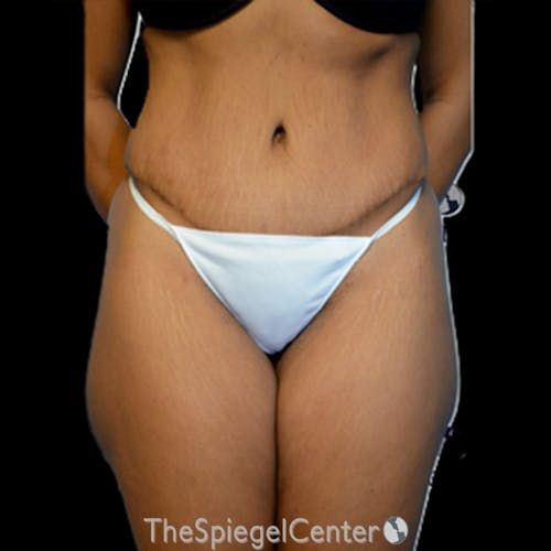 Body Contouring Before & After Gallery - Patient 147609 - Image 2