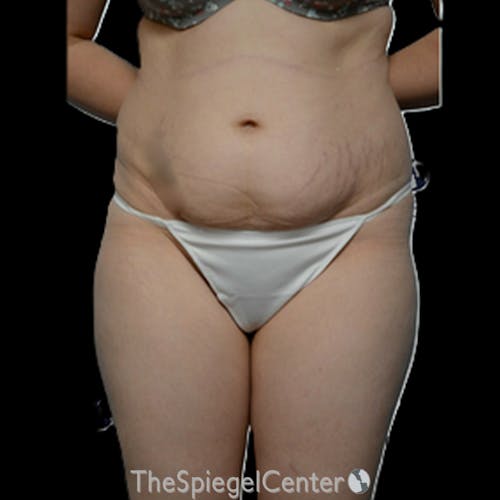 Body Contouring Before & After Gallery - Patient 230539 - Image 1