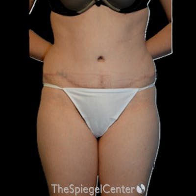 Body Contouring Before & After Gallery - Patient 230539 - Image 2