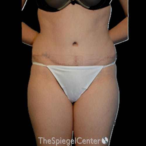 Body Contouring Before & After Gallery - Patient 230539 - Image 2