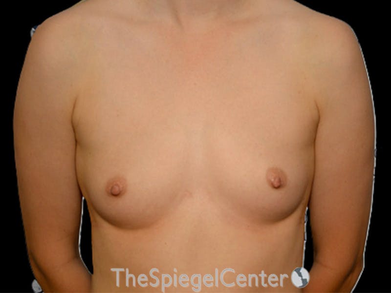 Breast Augmentation Before & After Gallery - Patient 231061 - Image 1