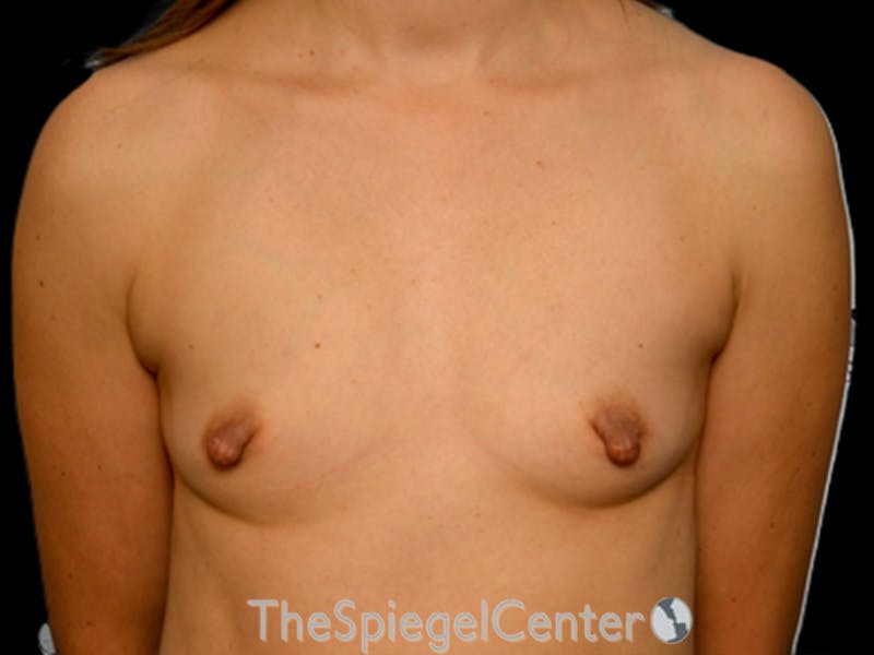 Breast Augmentation Before & After Gallery - Patient 354624 - Image 1