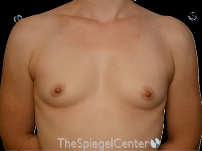 Breast Augmentation Before & After Gallery - Patient 143927 - Image 1