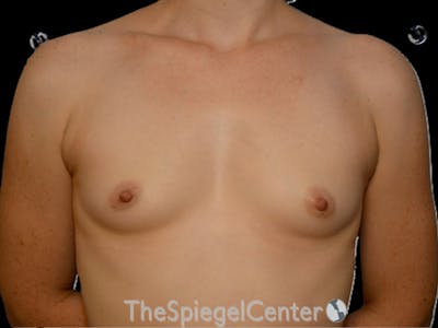 Breast Augmentation Before & After Gallery - Patient 143927 - Image 1