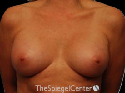 Breast Augmentation Before & After Gallery - Patient 255941 - Image 2