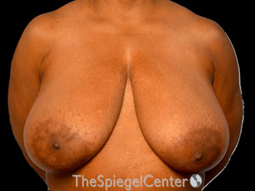 Breast Lift Before & After Gallery - Patient 350780 - Image 1
