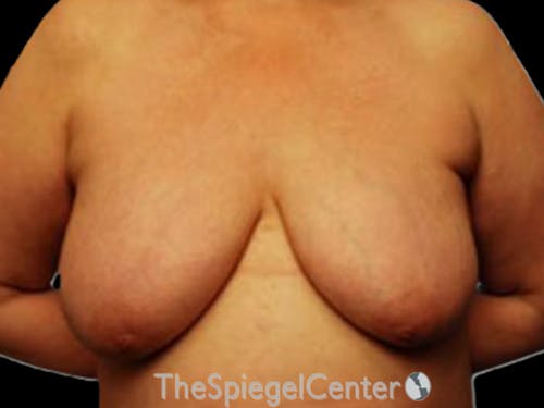 Breast Lift Before & After Gallery - Patient 222214 - Image 1