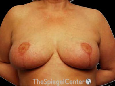 Breast Lift Before & After Gallery - Patient 222214 - Image 2