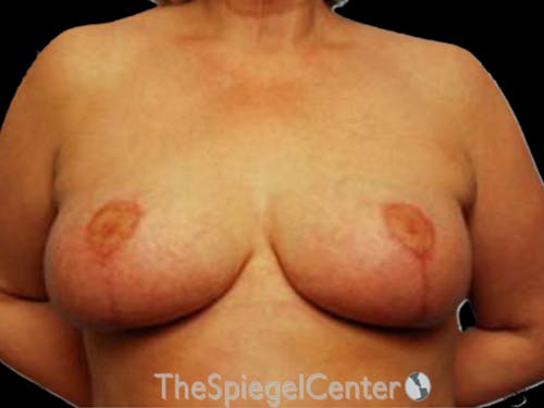 Breast Lift Before & After Gallery - Patient 222214 - Image 2