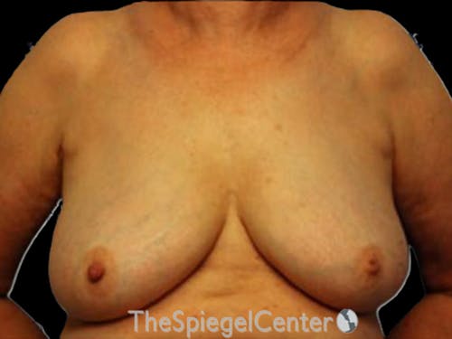 Breast Lift Before & After Gallery - Patient 708174 - Image 1