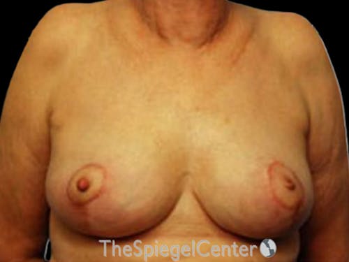 Breast Lift Before & After Gallery - Patient 708174 - Image 2