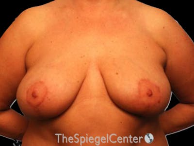 Breast Lift Before & After Gallery - Patient 345167 - Image 2