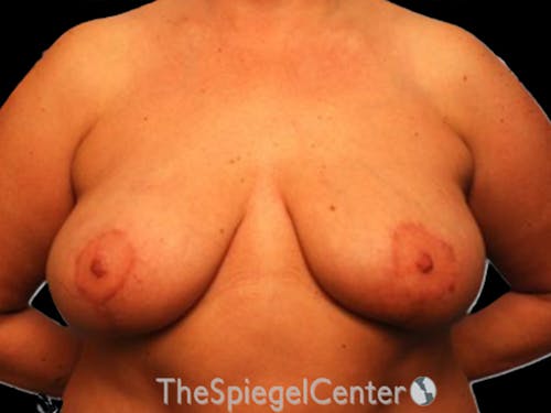 Breast Lift Before & After Gallery - Patient 345167 - Image 2
