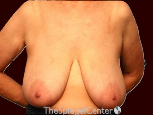 Breast Lift with Augmentation Before & After Gallery - Patient 876106 - Image 1