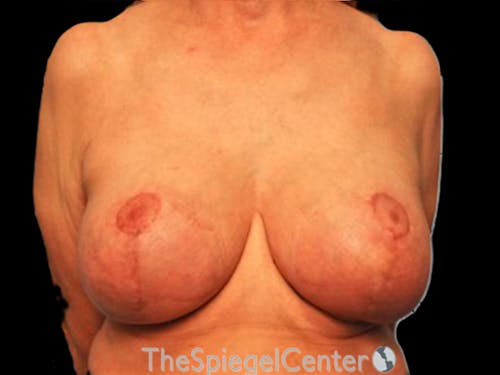 Breast Lift with Augmentation Before & After Gallery - Patient 876106 - Image 2