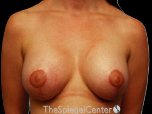 Breast Lift with Augmentation Before & After Gallery - Patient 582123 - Image 2