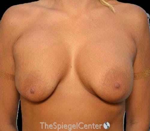 Breast Revision Before & After Gallery - Patient 413473 - Image 1