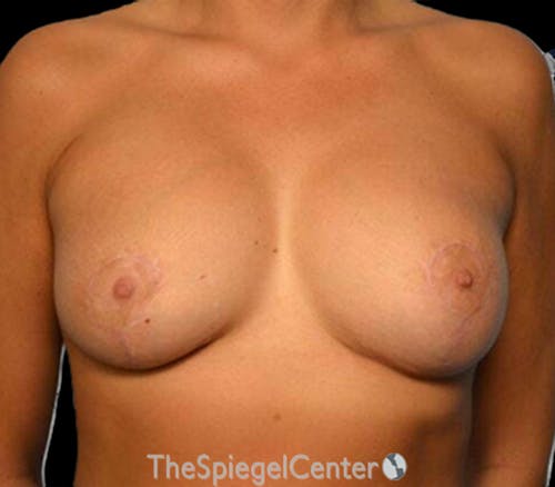 Breast Revision Before & After Gallery - Patient 413473 - Image 2