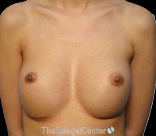 Breast Revision Before & After Gallery - Patient 495443 - Image 1
