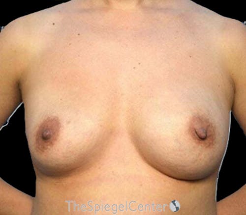 Breast Revision Before & After Gallery - Patient 339203 - Image 1