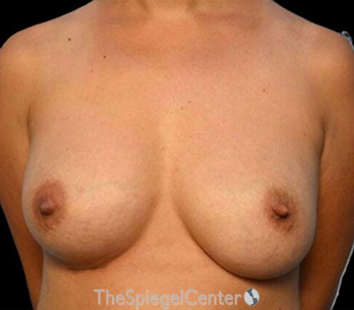Breast Revision Before & After Gallery - Patient 339203 - Image 2