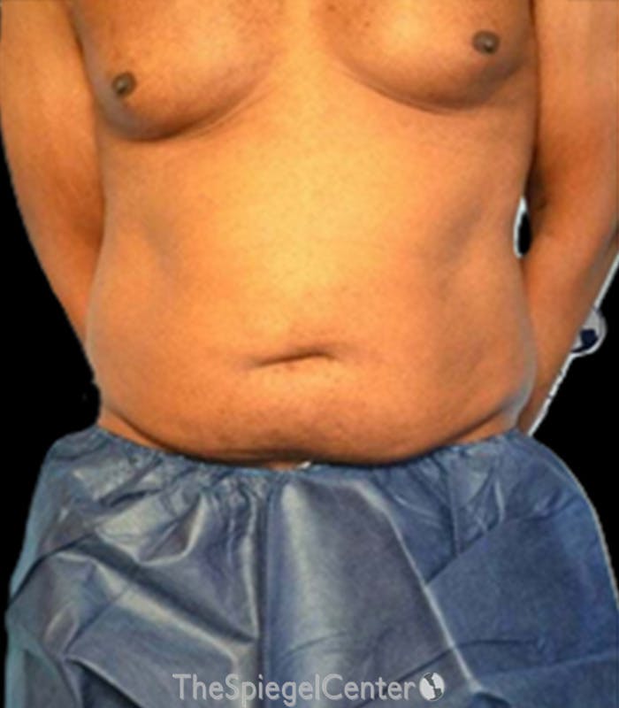 Mini Tummy Tuck Before & After Gallery - Patient 159553 - Image 1