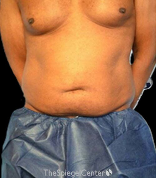 Mini Tummy Tuck Before & After Gallery - Patient 159553 - Image 1