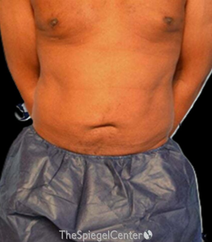 Mini Tummy Tuck Before & After Gallery - Patient 159553 - Image 2