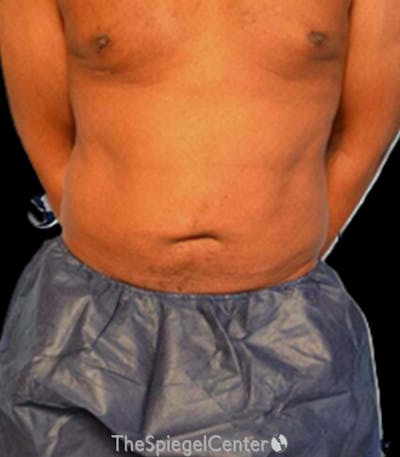 Mini Tummy Tuck Before & After Gallery - Patient 159553 - Image 2