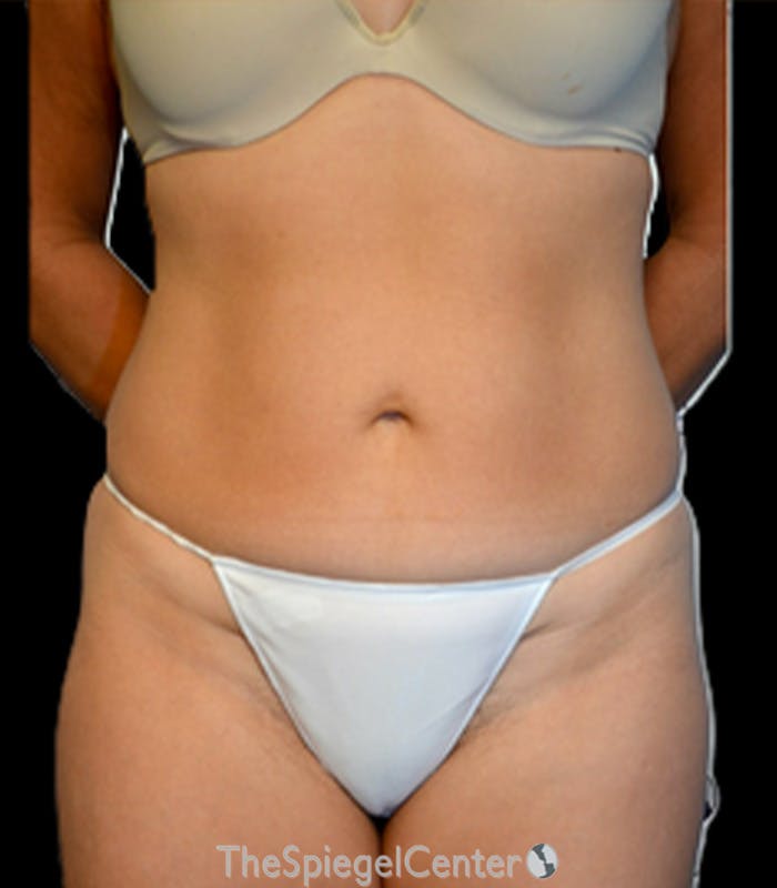 Mini Tummy Tuck Before & After Gallery - Patient 461825 - Image 1
