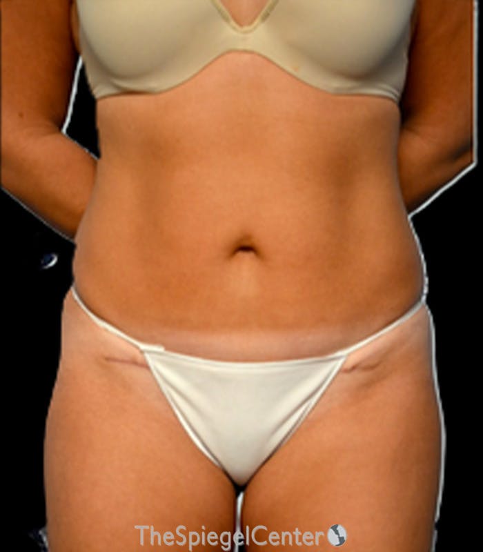 Mini Tummy Tuck Before & After Gallery - Patient 461825 - Image 2