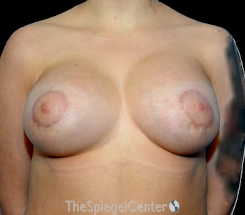 Tubular Breast Correction Before & After Gallery - Patient 186679 - Image 2