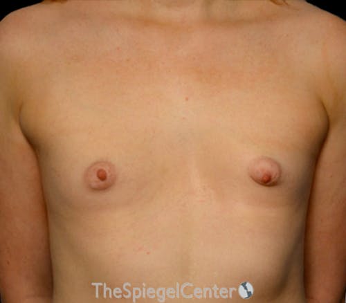Tubular Breast Correction Before & After Gallery - Patient 297728 - Image 1
