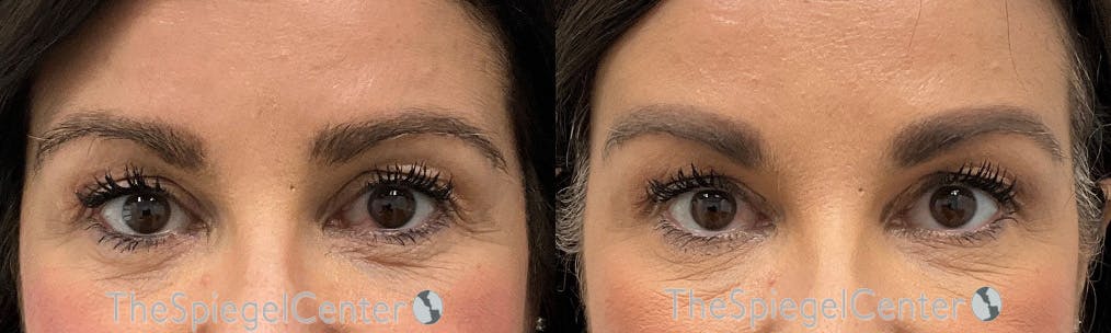 Brow Lift / Fox Eye Lift Before & After Gallery - Patient 615059 - Image 1