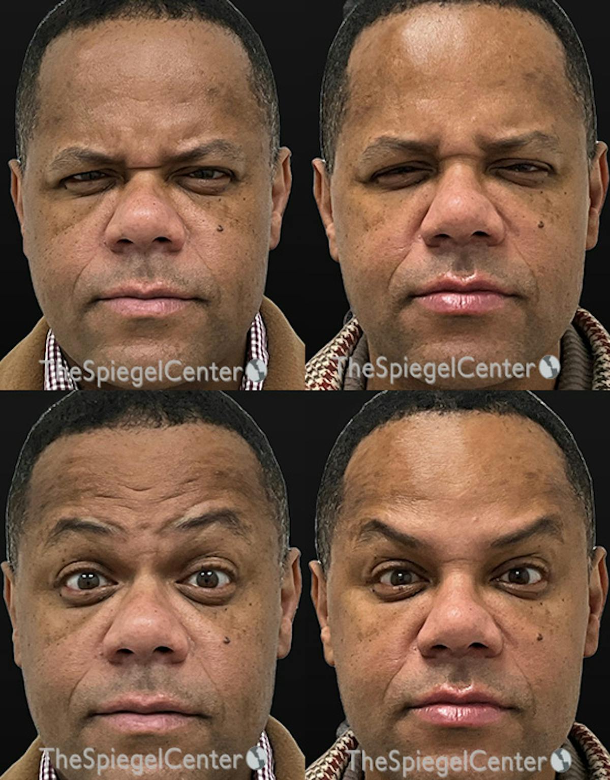Botox / Dysport / Jeuveau / Xeomin Before & After Gallery - Patient 236639 - Image 1
