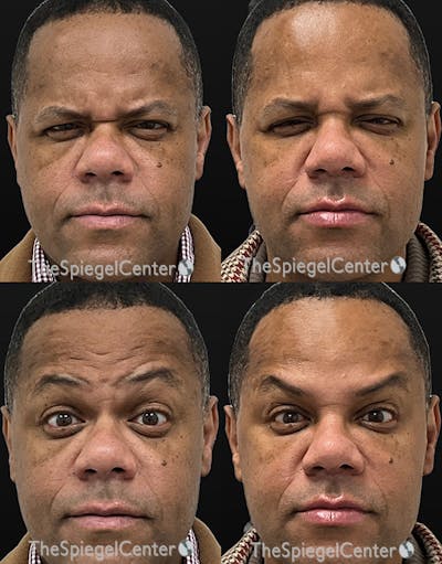Botox / Dysport / Jeuveau / Xeomin Before & After Gallery - Patient 236639 - Image 1