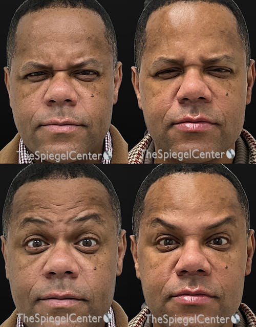 Botox / Dysport / Jeuveau / Xeomin Before & After Gallery - Patient 236639 - Image 1