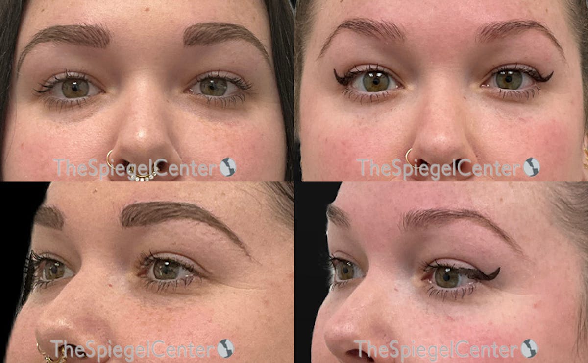 Tear Trough / Under Eye Fillers Before & After Gallery - Patient 808250 - Image 1