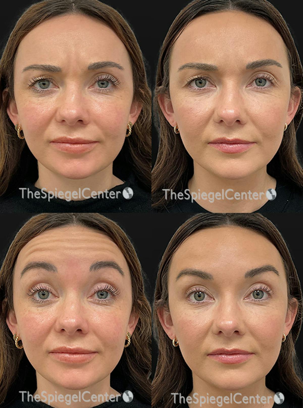 Botox / Dysport / Jeuveau / Xeomin Before & After Gallery - Patient 105154 - Image 1
