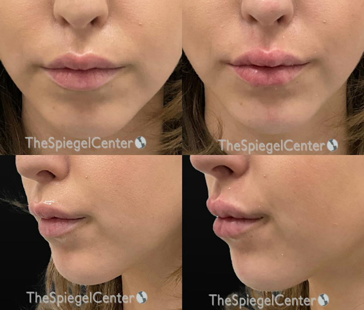Chin Filler Before & After Gallery - Patient 253237 - Image 1