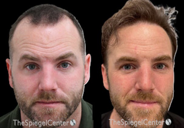 Hair Restoration Before & After Gallery - Patient 259065 - Image 1