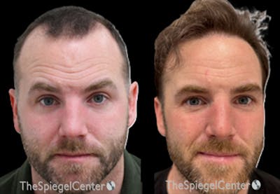 Hair Restoration Before & After Gallery - Patient 259065 - Image 1