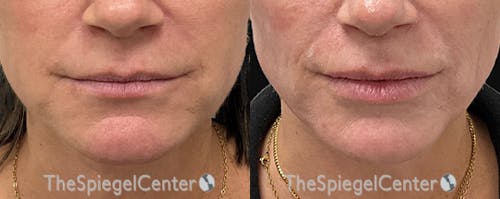 DOA Botulinum Before & After Gallery - Patient 414064 - Image 1