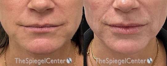 DOA Botulinum Before & After Gallery - Patient 414064 - Image 1