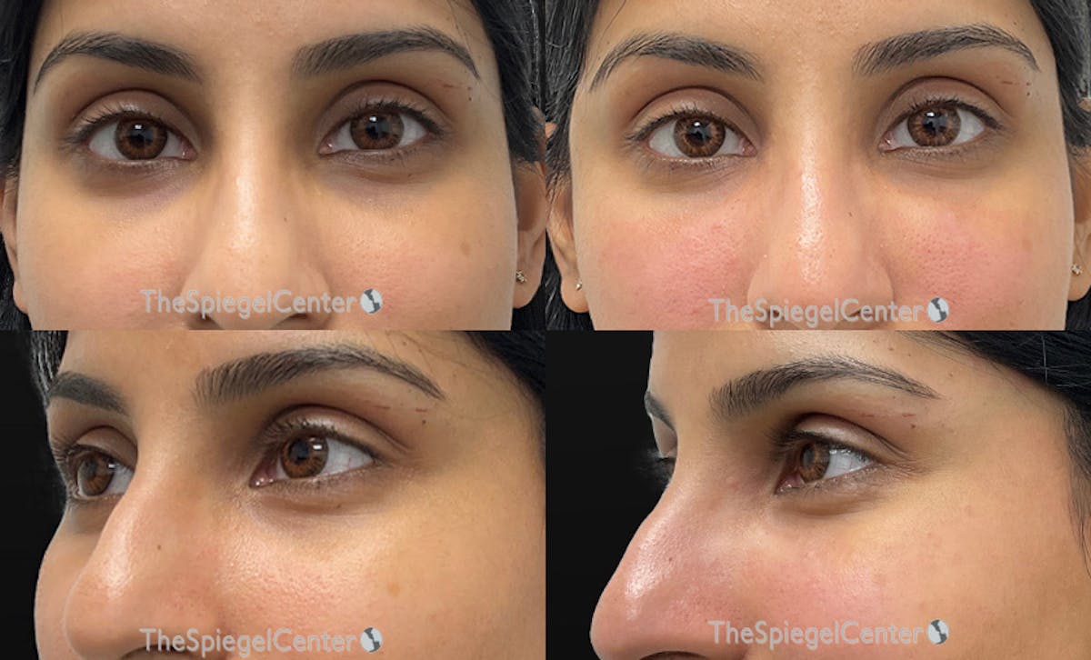 Tear Trough / Under Eye Fillers Before & After Gallery - Patient 318019 - Image 1