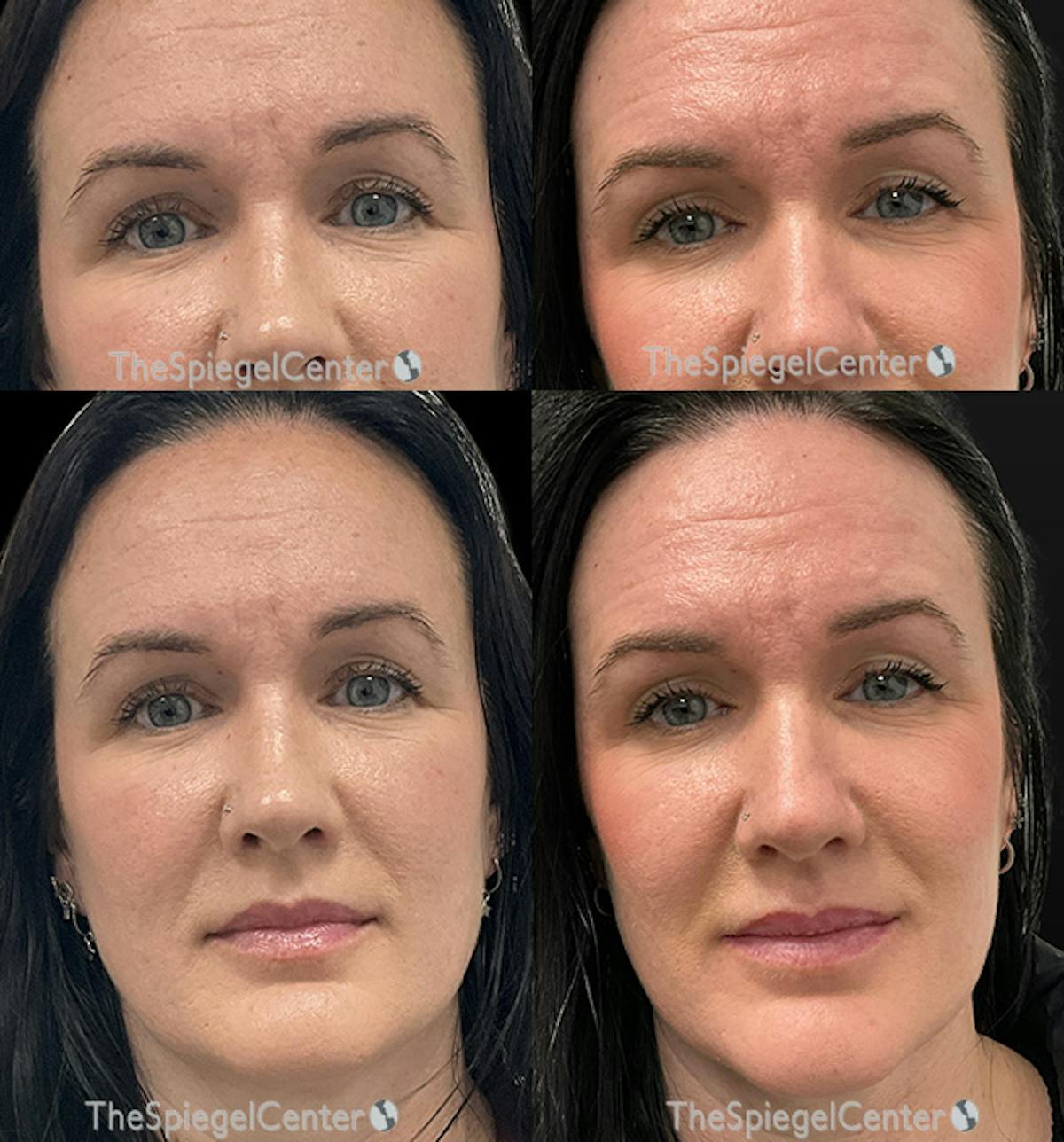 Temple Filler Before & After Gallery - Patient 140922 - Image 1